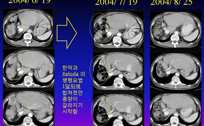 간암 2강  한약과 말기 간암사례 –&nbsp;소음인