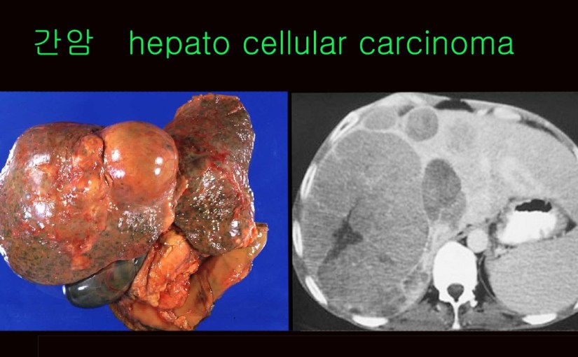 간암 1강  hepatoma 색전술과&nbsp;소음인