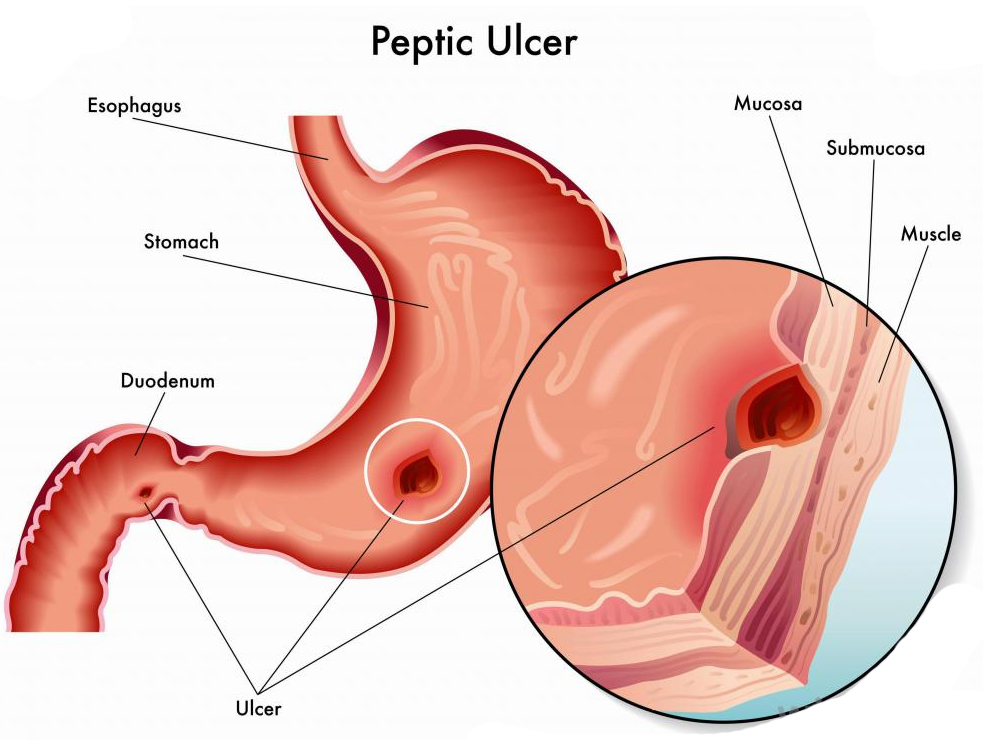 peptic ulcer.jpg