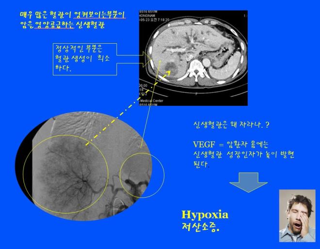 간암3-6.JPG