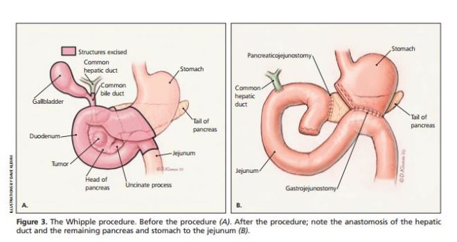 pancreas-11