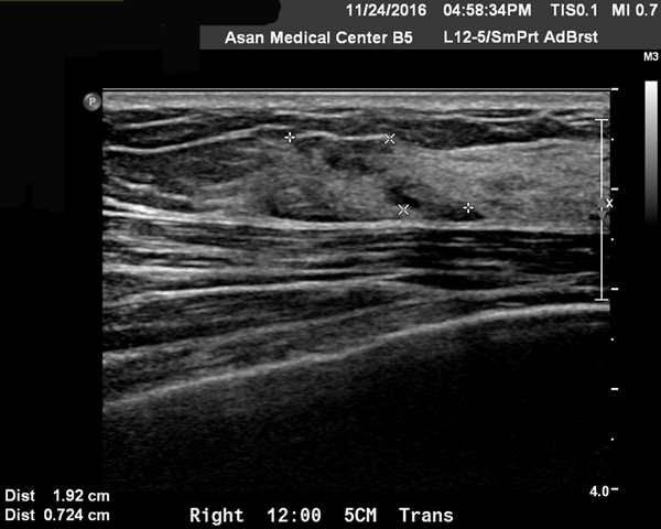 유방암 11강 – 수술 후 tamoxifen을 사용한 소양인 유방암 환자&nbsp;이야기