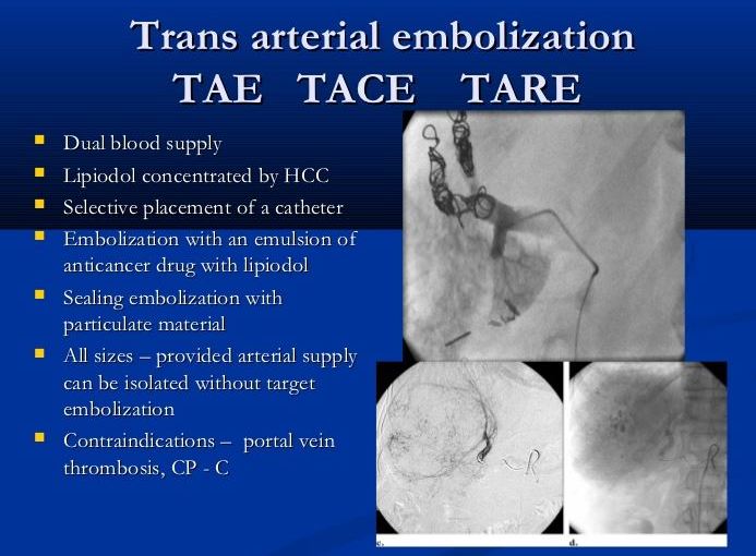 간암 6강. 색전술로장기생존 의 간암환자 재발이후에 간이식을 기다리는상태에서&nbsp;한방치료