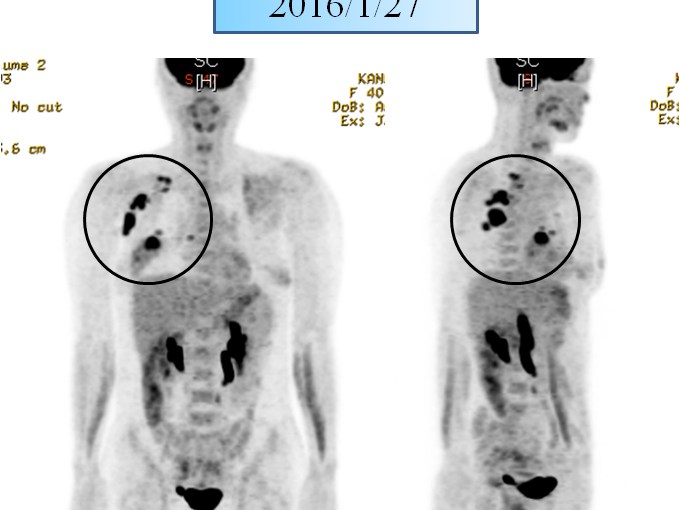 유방암 10강 – 유방암3기 – 양방치료를 거부한   소양인 유방암 환자이야기 – 양측성 종양과 겨드랑이 림프절&nbsp;전이