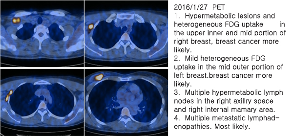 유방암 13강 –  10강의 소양인 유방암 환자의 CT&nbsp;비교