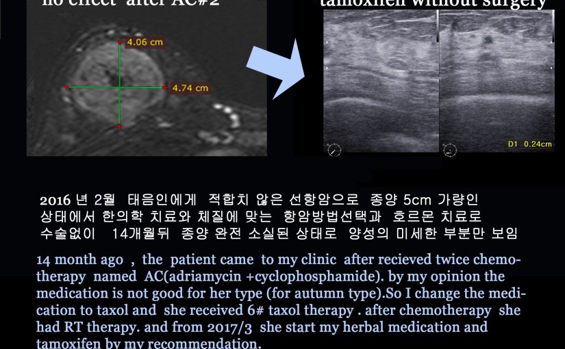 유방암 12강. 수술 전 항암으로 수술을 피해 갈 수 있는가? 수술 없이 치료할 수는&nbsp;없는가?