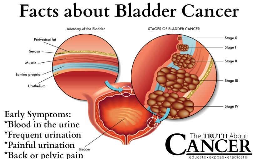 방광암 1강. 수술이 불가능한 방광암 환자의&nbsp;한방치료